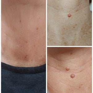 הסרת תגי עור ללא צלקת קטיה גיגי קוסמטיקאית רמת אביב