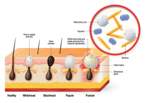 NOON KATYA GIGI COSMETICS טיפול באקנה ACNE קטיה גיגי רמת אביב ג קוסמטיקאית תל אביב דאבל פייט / Double Fight